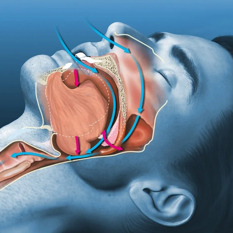 What Is a Sleep Apnea Appliance?